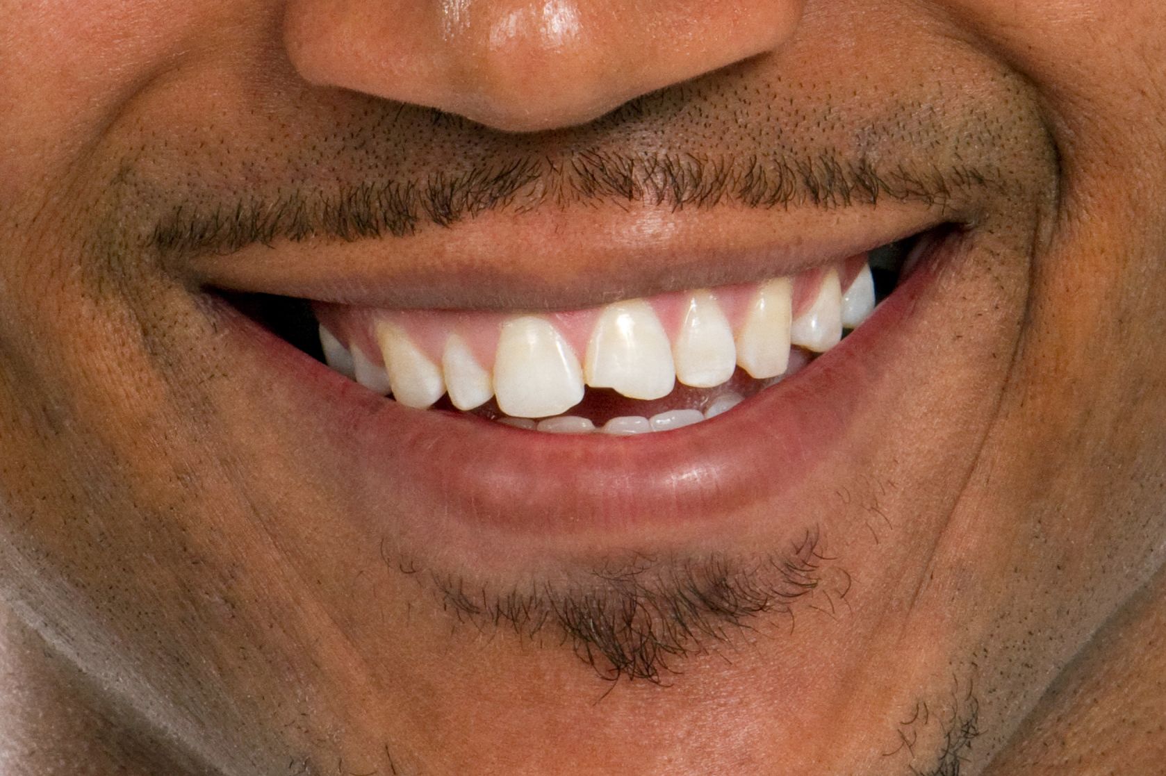 man with chipped tooth