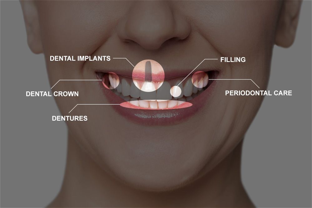 Illustration of different procedures that can make up a full mouth reconstruction