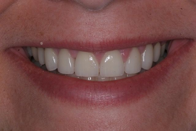 Veneers and crowns after