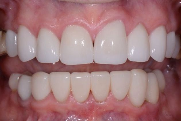after veneers
